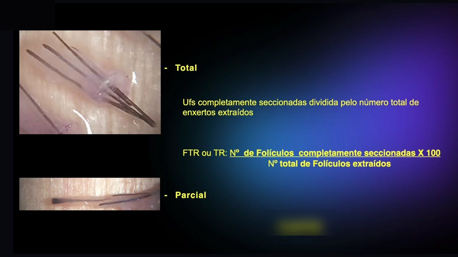 Slide da aula: folículos extraídos vistos ao microscópio